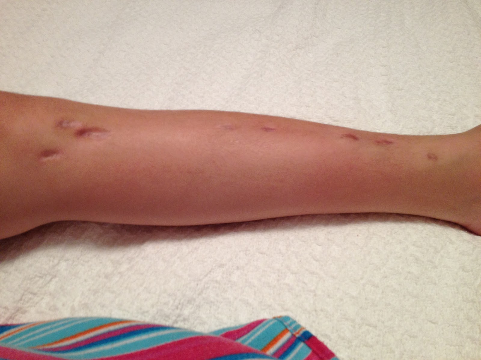 fibular hemimelia leg lengthening: Photos at 7 1/2 months: scars, feet and leg
